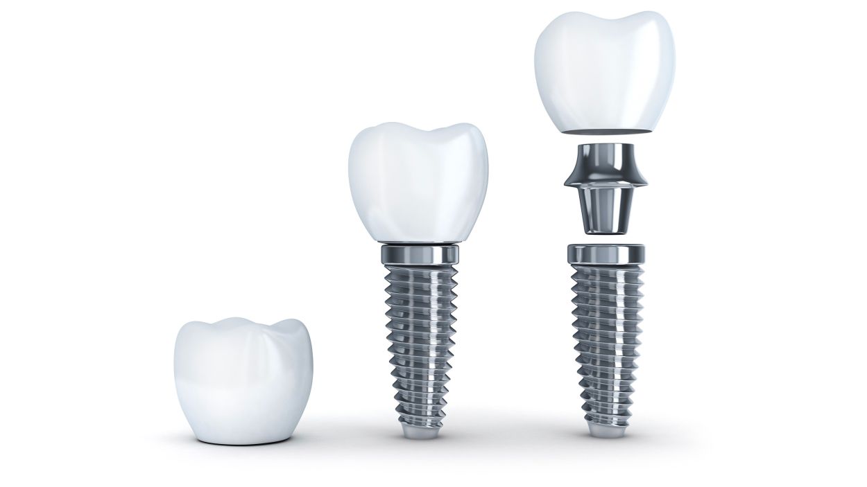 Dental Implants at Oakley Dental