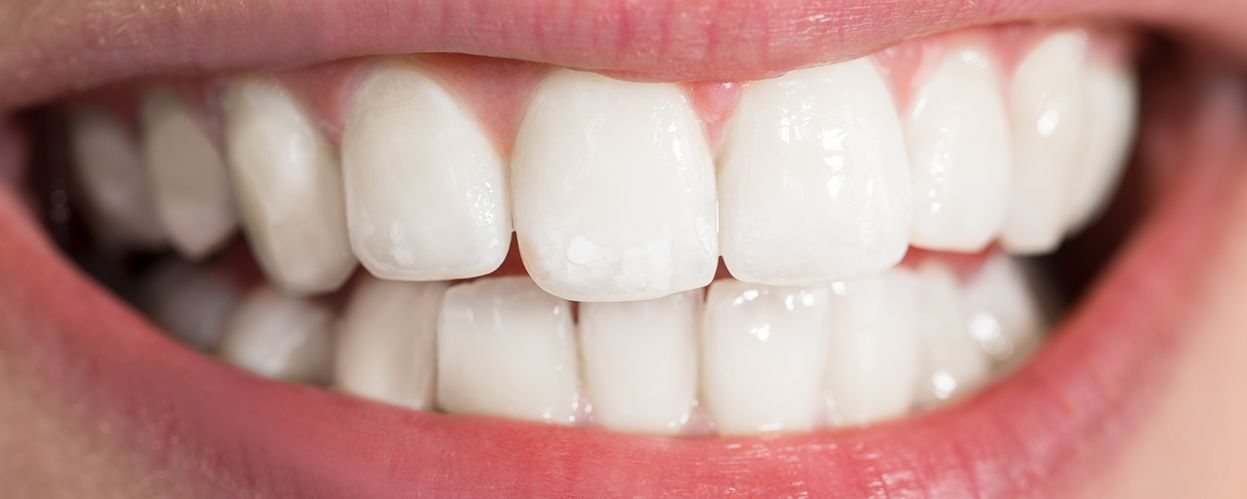 Half Price Hygiene offer for New Patients