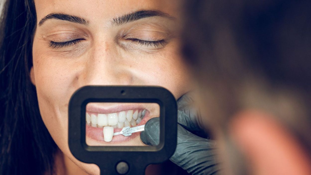Christmas Composite Bonding Offer in Prestwich | From £200 per Tooth