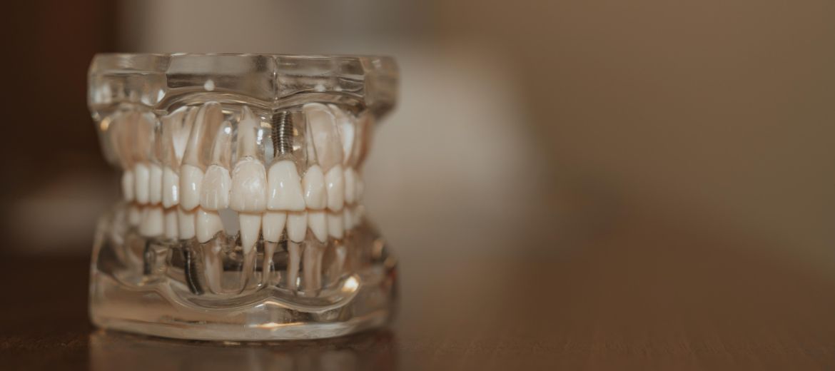 Dental Implants
