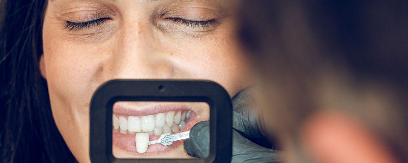Christmas Composite Bonding Offer in Prestwich | From £200 per Tooth