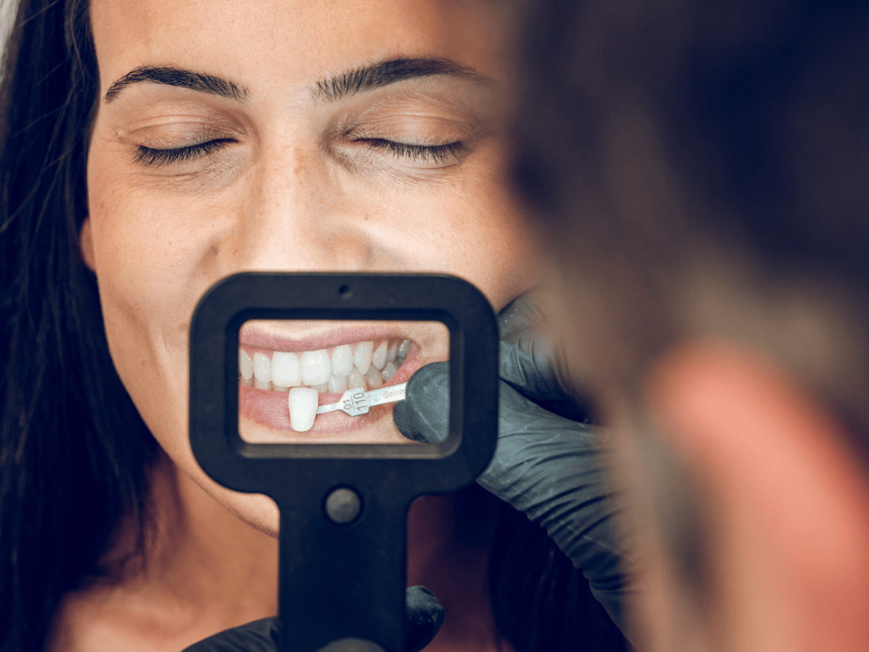 White fillings at Oakley Dental