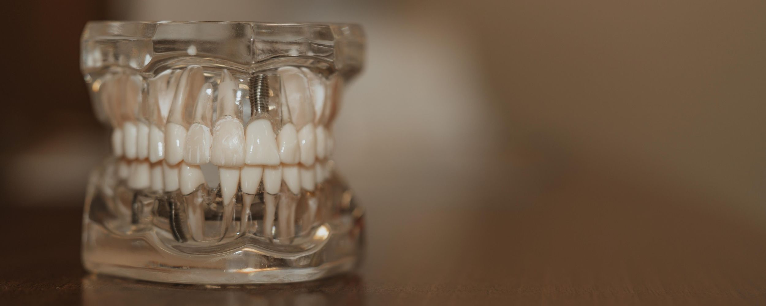 Dental Implants in Prestwich