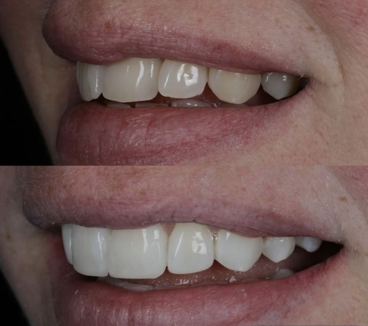 Before and after Tooth Whitening at Oakley Dental