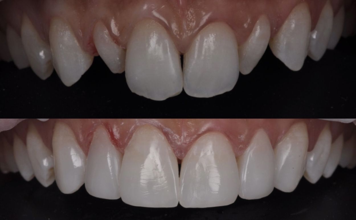 Before and after composite bonding at Oakley