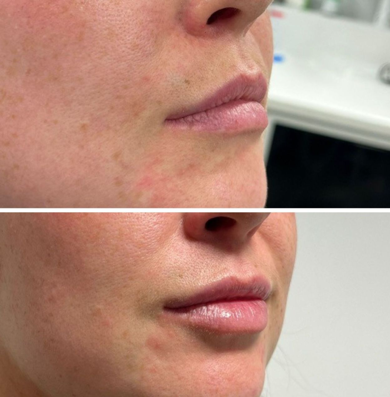 dermal fillers