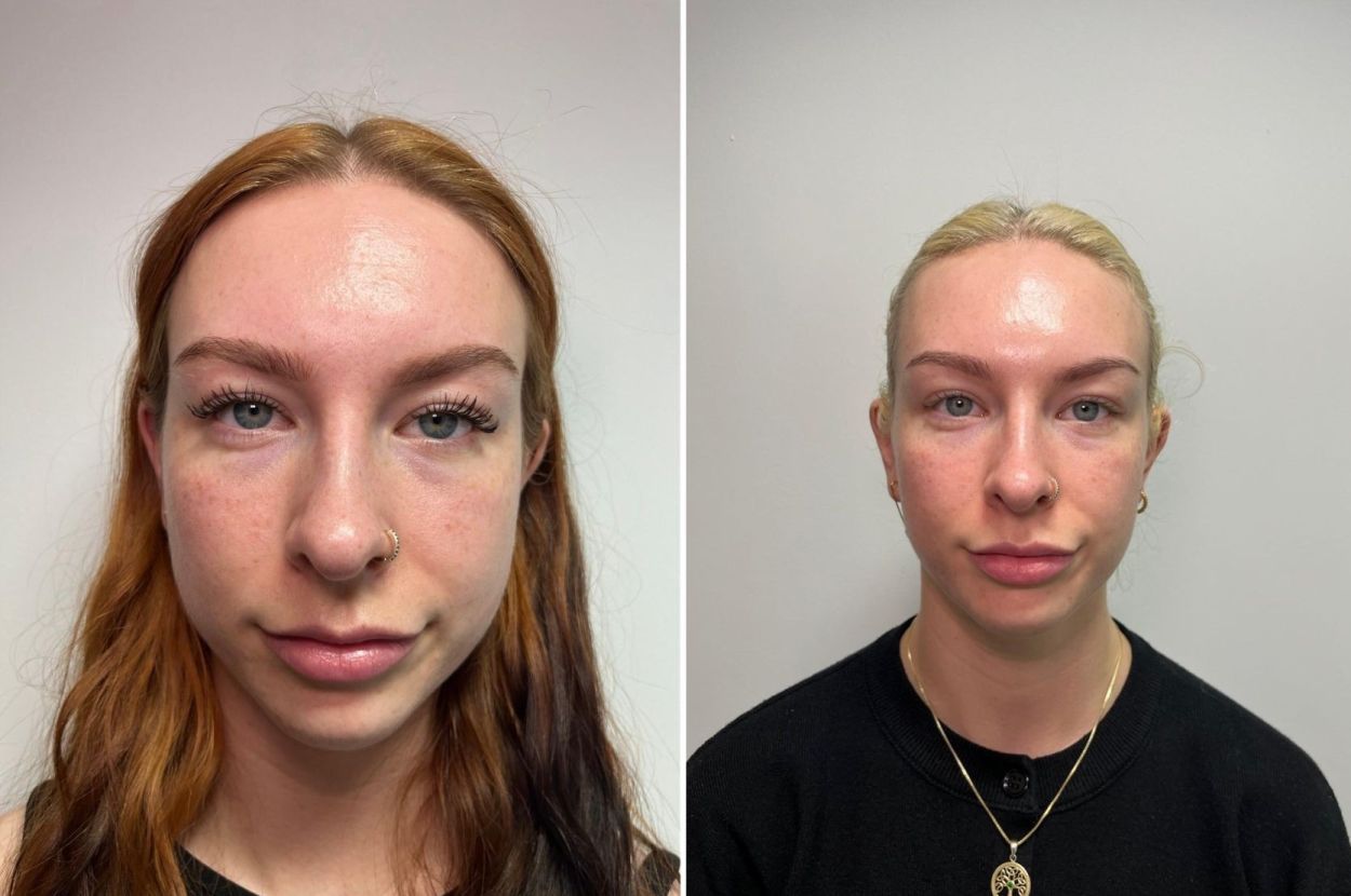 Consultation for Lines and Wrinkles