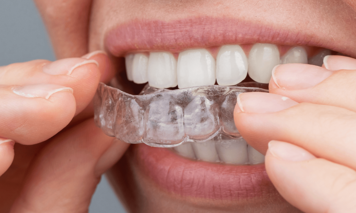 Teeth Straightening at Oakley