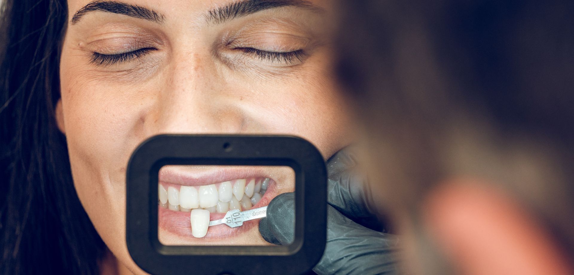 Christmas Composite Bonding Offer in Prestwich | From £200 per Tooth