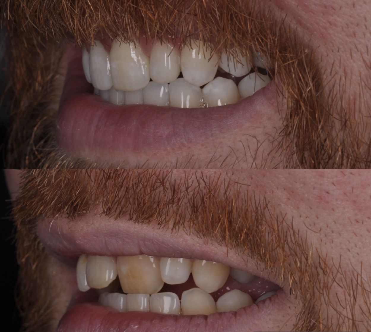 Before and after Invisalign at Oakley Dental