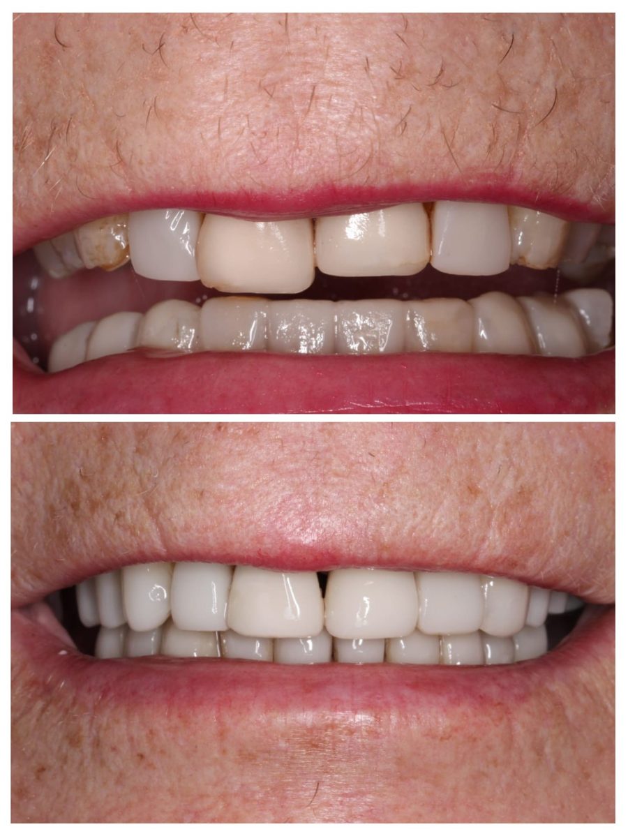 Before and after composite bonding at Oakley Dental: uneven, discoloured front teeth (top) and an even, brighter smile after treatment (bottom)