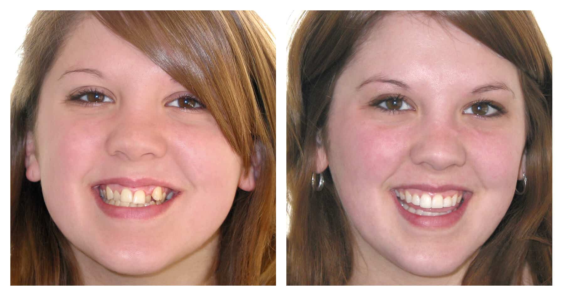 Six Month Smiles Prestwich, Whitefield by Oakley Dental Manchester
